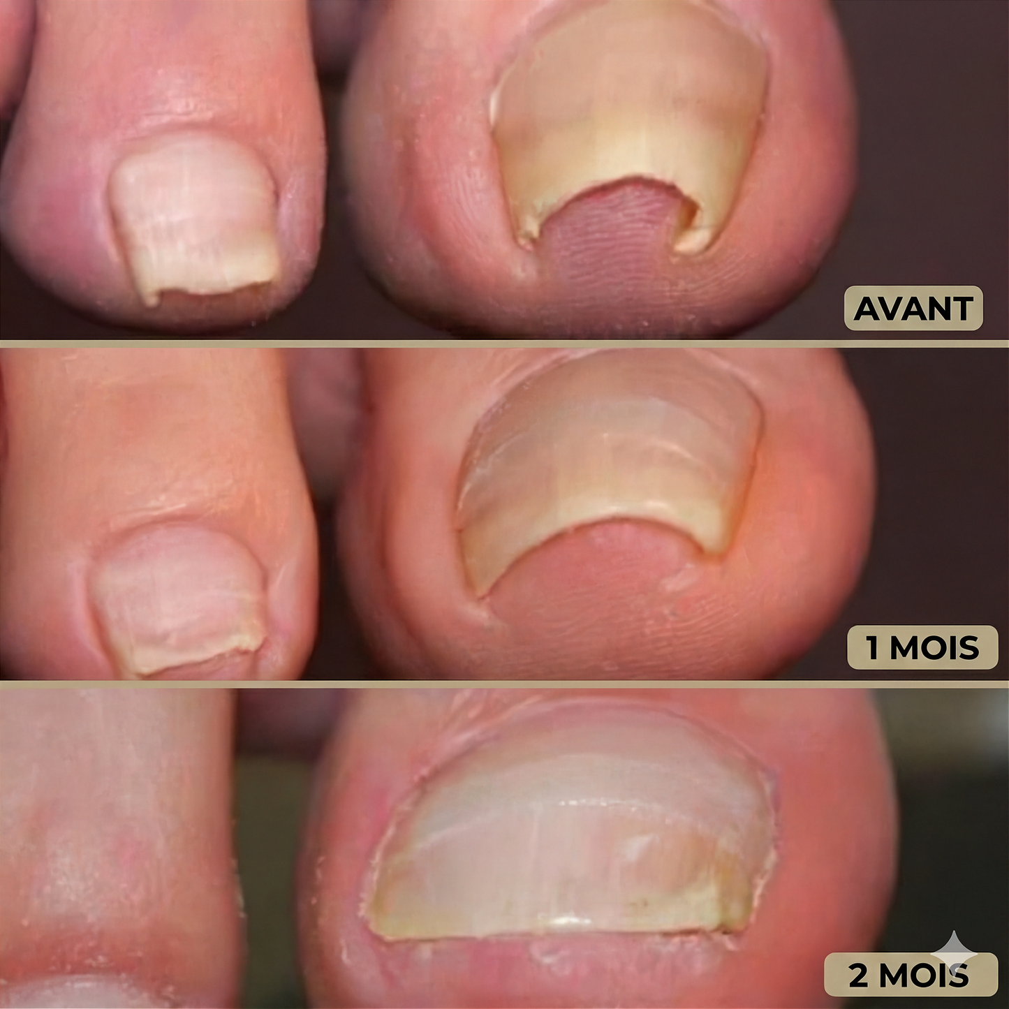 OngléFix – Correcteur d'ongles incarnés | Soulagement rapide & sans douleur