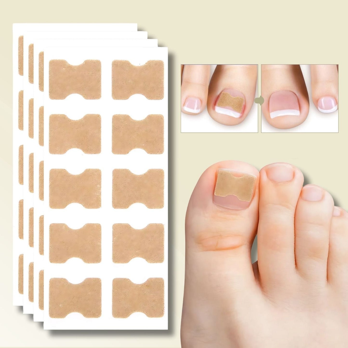 OngléFix – Correcteur d'ongles incarnés | Soulagement rapide & sans douleur