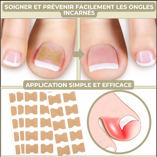 OngléFix – Correcteur d'ongles incarnés | Soulagement rapide & sans douleur